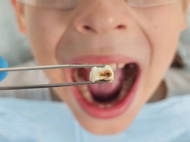 Best Emergency Treatment for Dental Infections or Abscesses in West Hills, PA